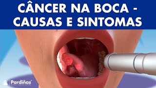 CÂNCER DE BOCA  Causas sintomas e tipos de tumores na boca © [upl. by Atrim]