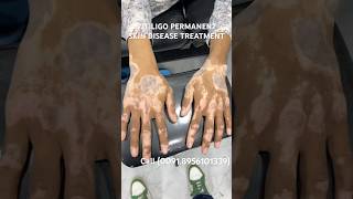 VITILIGO SKIN DISEASE PERMANENT TREATMENT  WHITE SPOTS TREATMENT  LUEKODERMA CURE vitiligocures [upl. by Leddy]