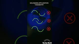 goldmann applnation tonometry [upl. by Alburg]