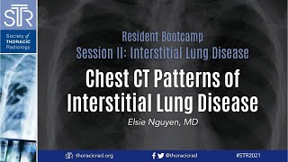 How to Interpret a Chest XRay Lesson 6  Diaphragm and Pleura [upl. by Robillard]