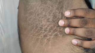 Acanthosis Nigricans [upl. by Iram750]