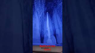 radicular cystviralshort shortvideo dentaltreatment periapical cystdentist [upl. by Durwyn]