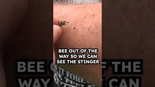 How to Remove Bee Sting [upl. by Aremmat486]