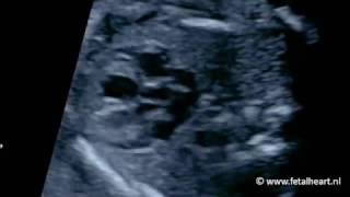 Fetal heart Academy  Normal heart 1 LVOT [upl. by Fairley]