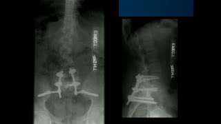 The Role of Reduction in Dysplastic Spondylolisthesis  Sigurd Berven MD [upl. by Nadruoj622]