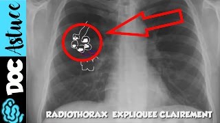 🔴 5 Dr Astuce  APPRENDS LE SYNDROME ALVEOLAIRE EN  DE 5 MIN  partie 1  Dr Astuce [upl. by Gridley]