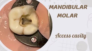 Access opening of Mandibular Molar [upl. by Adaliah178]