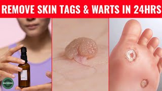 How to Rid Skin Tags and Warts Within 24 Hours  Skin Tag Removal with Garlic amp PovidoneIodine [upl. by Lontson]