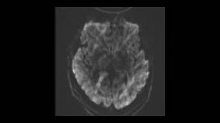 MRI BRAIN TBI Set 7 [upl. by Cormac]