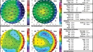 corneal topography galilei g 4 scan eye allergy test laser Urdu Hindi [upl. by Odnamla]