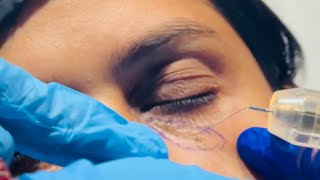 Is Bar Laser Xanthelasma Removal Karwa Liya  Cholesterol Deposit [upl. by Yud]