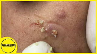 Suri Job 96 HIDDEN ACNE AND BLACKHEADS EXTRACTION [upl. by Aissatan]