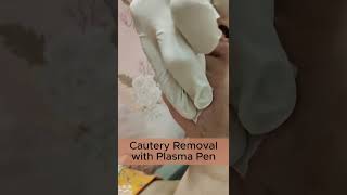 Cautery Removal with Plasma Pen [upl. by Pierce]