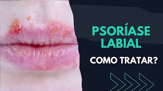 PSORÍASE LABIAL COMO TRATAR  SAIBA [upl. by Anilegnave]