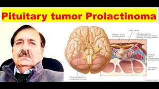 Prolactinoma Signs Symptoms diagnosis and Treatment Lectures by Dr Alamzeb [upl. by Laux]