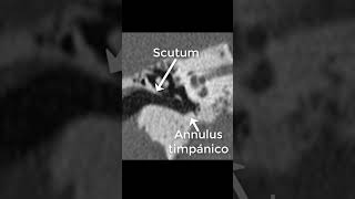 Scutum amp Annulus Timpánico TAC [upl. by Eninahs]