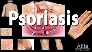 Psoriasis Types Symptoms Causes Pathology and Treatment Animation [upl. by Halverson]