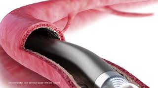 TurboPower laser atherectomy animation [upl. by Ahsienal939]