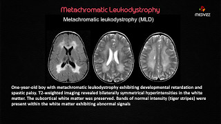 Metachromatic Leukodystrophy  USMLE Biochemistry webinar Case based lecture [upl. by Tamberg636]