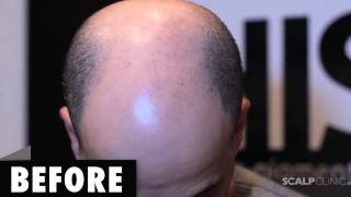 Natural Soft Hairline Scalp Micropigmentation  Hair Loss Scalp Clinic [upl. by Imogen]