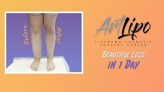 Lipedema Leg Transformation  Cankles amp Knees Complex   Lipo 360°  Expert Dr Thomas Su [upl. by Ajuna]