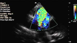 Patent Ductus Arteriosus in a dog [upl. by Kirima]