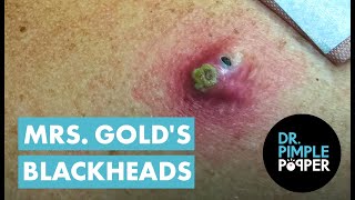 Mrs Golds Back Blackhead Extraction Session  Addressing the Inflamed One [upl. by Koehler]