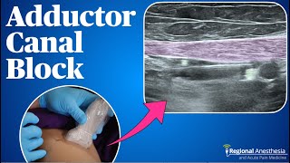 Adductor Canal Block 2024 update [upl. by Nadiya]