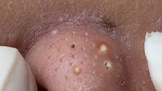 Big Cystic Acne Blackheads Extraction Blackheads amp Milia Whiteheads Removal Pimple Popping  3709 [upl. by Fishbein]