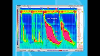 Esophageal Motility Disorders Part 2 [upl. by Assirhc]