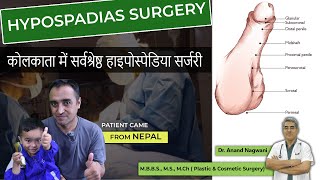 Best HYPOSPADIAS Surgery in Kolkata  Patient Came from Nepal  Best Age for Hypospadias Surgery [upl. by Yvehc]