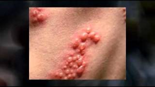 Antiviral Drugs For Shingles Rashes [upl. by Aikin445]