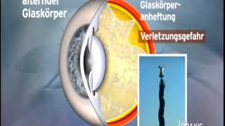 Glaskörpertrübungen im Auge [upl. by Belle]