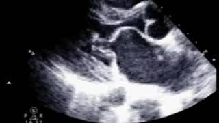 Mitral Stenosis  Echo Clip [upl. by Revolc]