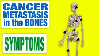 Cancer Metastasis in the Bones  All Symptoms [upl. by Linoel]