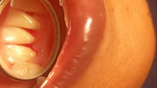 clear your doubts about a scaling procedure at a dentist all answered do watch till the end [upl. by Ahsatniuq]