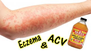 How To Treat Eczema with Apple Cider Vinegar [upl. by Garrard]