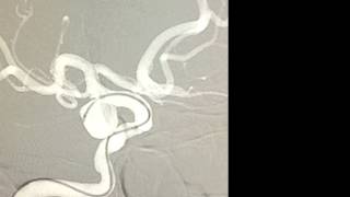 Endovascular coil embolization of unruptured posterior communicating artery aneurysm [upl. by Norri]