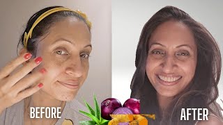 How to remove PIGMENTATION from Face Naturally AT HOME  झाइयां हटाने के नुस्खे [upl. by Niveg]