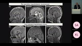 Pediatric Craniopharyngioma Pt1 Craniopharyngioma  Overview and Classification [upl. by Gerrald]