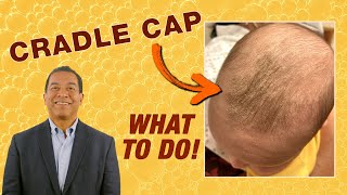 Cradle Cap Pediatrician’s Tips for Parents Seborrheic Dermatitis  AAP [upl. by Niboc]