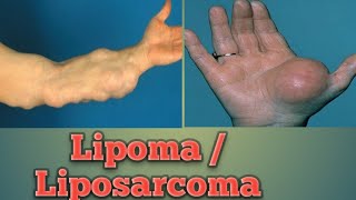 Lipoma  Liposarcoma Cancer Pathology Oncology Cancer [upl. by Anehsuc]