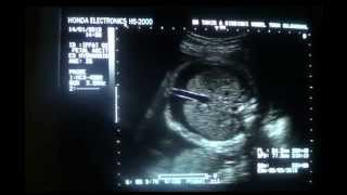 FETAL ASCITES with PLEURAL EFFUSION and HYDRAMNIOS [upl. by Darrell]