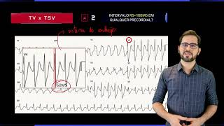 ENTENDA os Critérios de Brugada para TV x TSV em 3D [upl. by Ameline792]