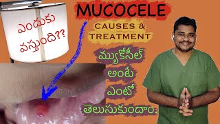 MUCOCELE  Causes amp Treatment of Mucocele  మ్యుకొసీల్ అనే ఈ కండిషన్ పిల్లలో ఏకువగా వస్తుంది [upl. by Claudell834]