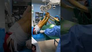 Operation theatre lithotomy positionMBBS surgery sohorts shortsyoutube operationpolo [upl. by Lanos220]