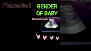 BABY GENDER VS PLACENTA shortsfeedpregnancy [upl. by Drusus216]