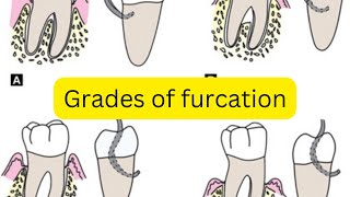 Grades of furcation involvement MADE EASY [upl. by Pincas]