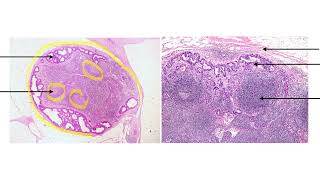 ADENOCARCINOMA METASTASIS TO LYMPH NODE [upl. by Ekoorb250]