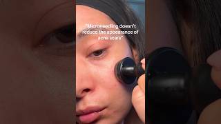 How to boost collagen elastin and improve texture and acne scars over time🙌🏽 microneedlingface [upl. by Nandor]